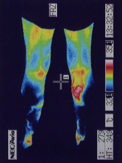 小腿血流的热成像测试。