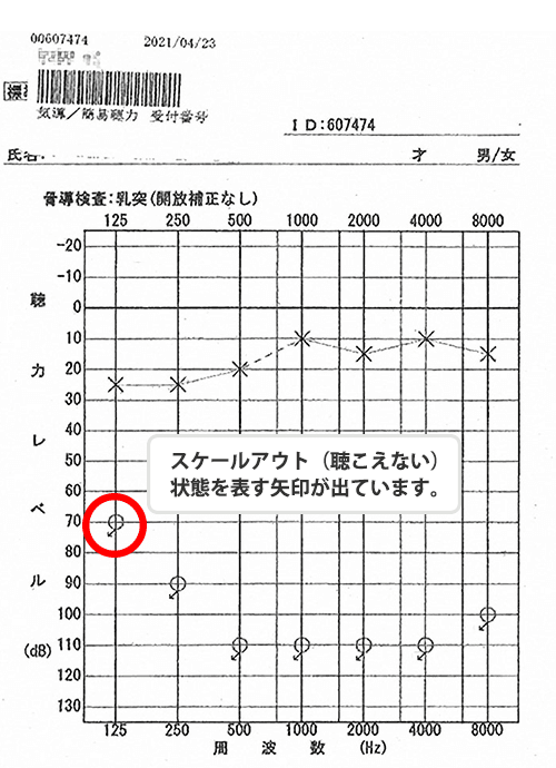 因突发性听力损失出院后，立即按比例做了整个地区的听力图。