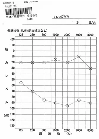 针灸师通过针灸治疗开始恢复听力