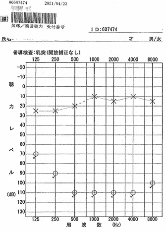 由于突发性听力损失出院后，整个区域立即缩小。