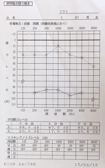 听觉替代现象 治疗前听力图