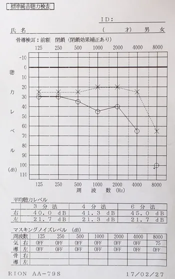 听觉替代现象 治疗后听力图