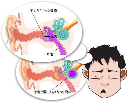 耳蜗鼓膜受压，丧失低频听力/耳蜗鼓膜受压，内耳受损，丧失低频听力。